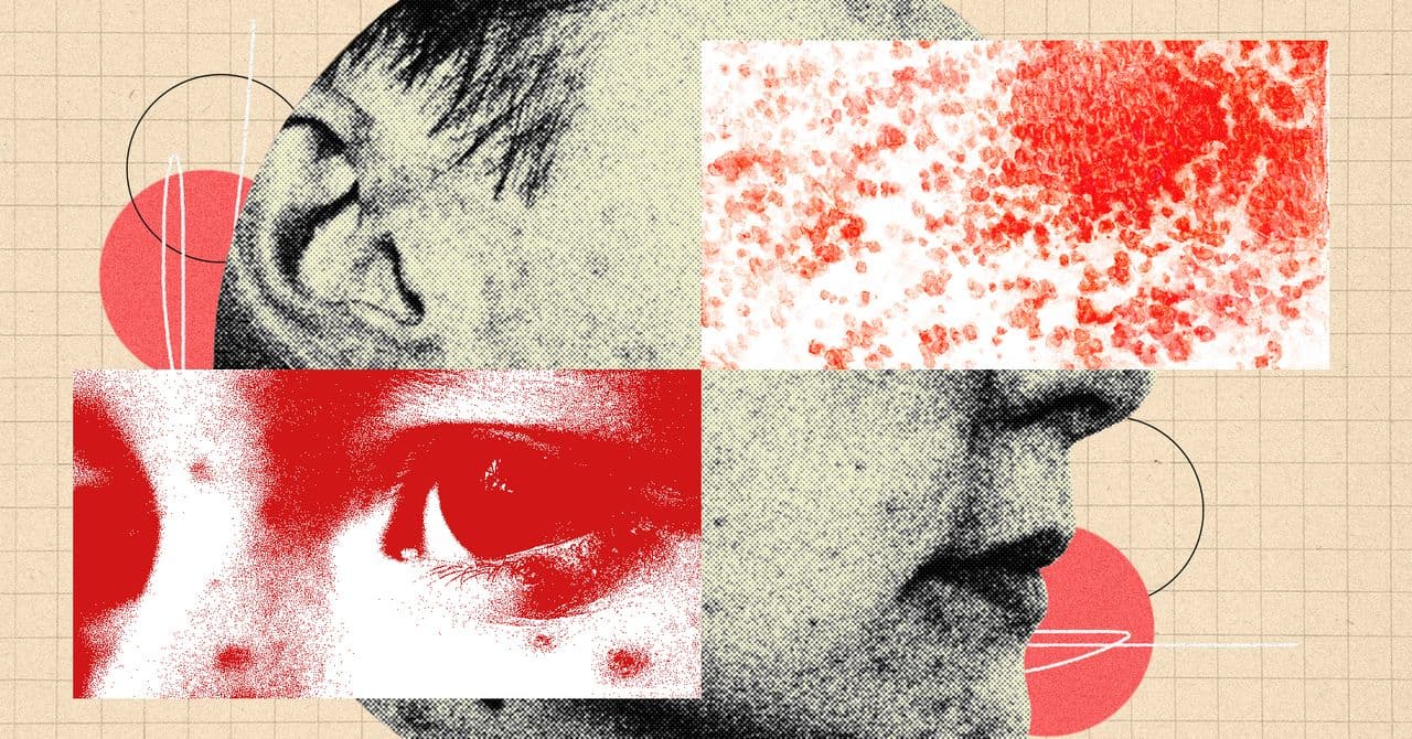 You Need to Be More Freaked Out by Shingles